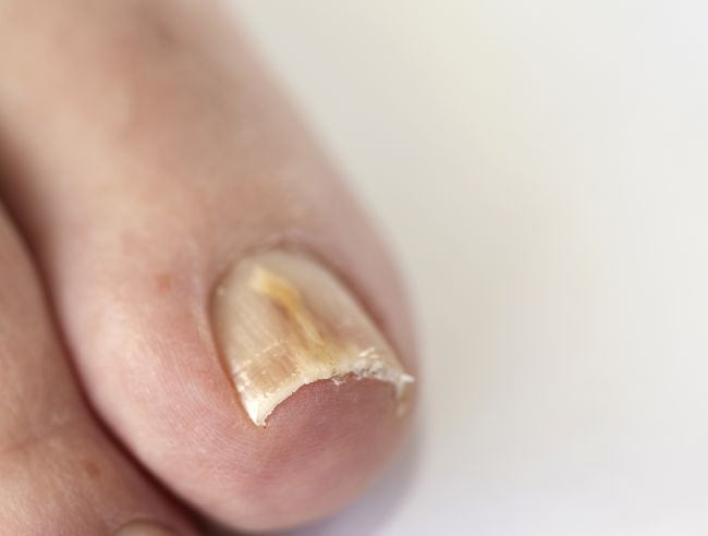 dacă ciuperca a apărut pe unghii este un semn cum să vindeci ciuperca de pe unghiile mâinilor